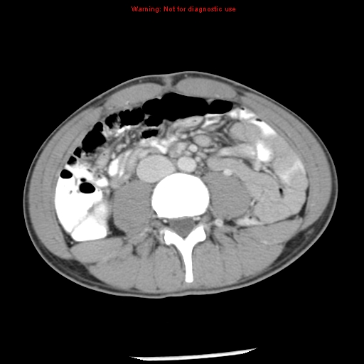 Acute appendicitis (Radiopaedia 8195-9045 Axial C+ portal venous phase 41).jpg