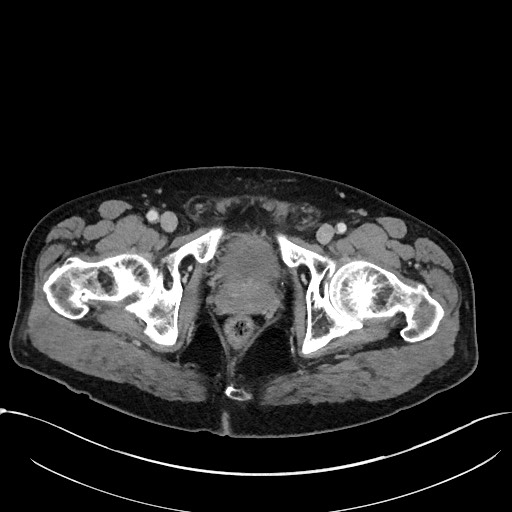 Acute appendicitis - large appendicoliths (Radiopaedia 61805-69820 Axial C+ portal venous phase 129).jpg