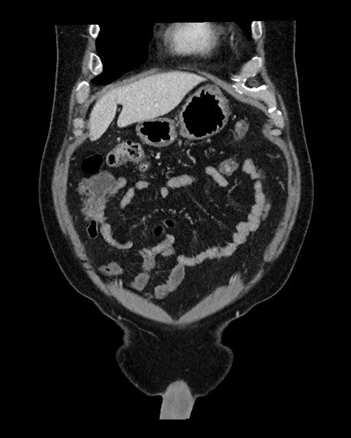 Acute appendicitis - large appendicoliths (Radiopaedia 61805-69820 Coronal C+ portal venous phase 33).jpg