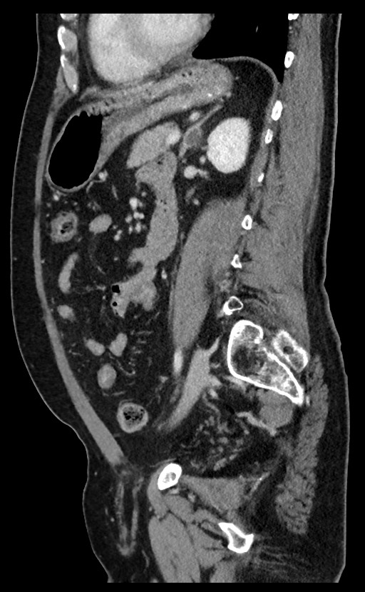 Acute appendicitis - large appendicoliths (Radiopaedia 61805-69820 Sagittal C+ portal venous phase 44).jpg