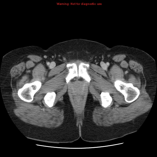 Acute appendicitis complicated by ovarian vein thrombophlebitis (Radiopaedia 16172-15851 Axial C+ portal venous phase 89).jpg