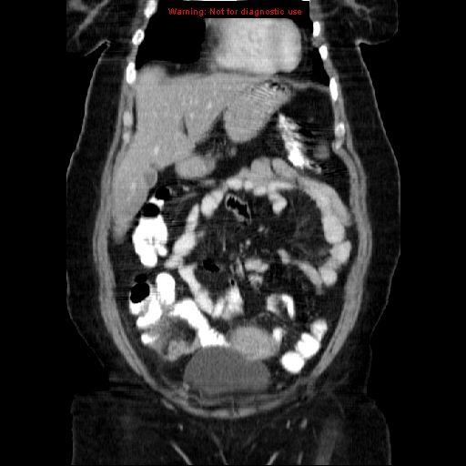 File:Acute appendicitis complicated by ovarian vein thrombophlebitis (Radiopaedia 16172-15851 Coronal C+ portal venous phase 26).jpg