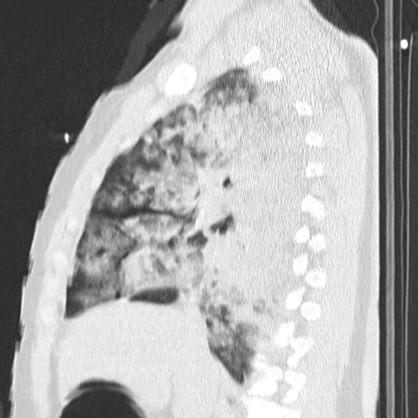 Acute aspiration pneumonitis (Radiopaedia 33605-34703 Sagittal lung window 37).jpg