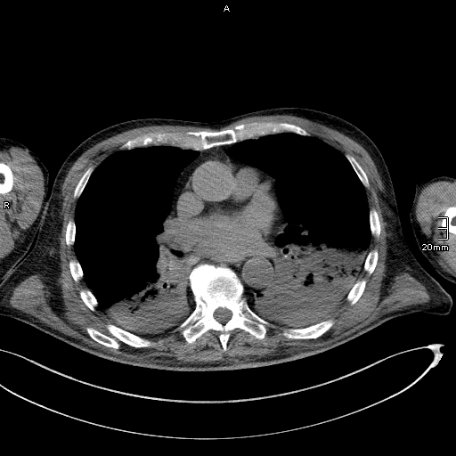 File:Acute aspiration pneumonitis (Radiopaedia 55642-62166 Axial liver window 34).jpg