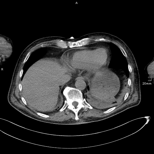 Acute aspiration pneumonitis (Radiopaedia 55642-62166 Axial liver window 51).jpg