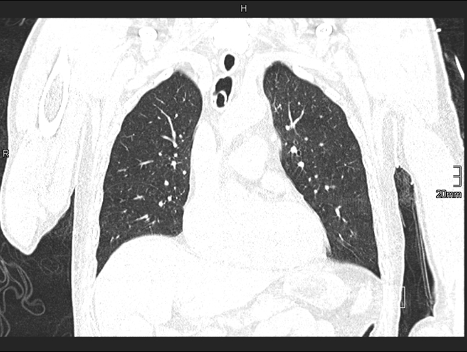 File:Acute aspiration pneumonitis (Radiopaedia 55642-62166 Coronal lung window 39).jpg