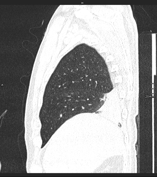 File:Acute aspiration pneumonitis (Radiopaedia 55642-62166 Sagittal lung window 129).jpg