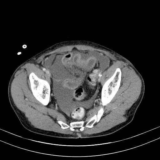 Acute bowel ischemia (Radiopaedia 87695-104114 Axial C+ portal venous phase 74).jpg