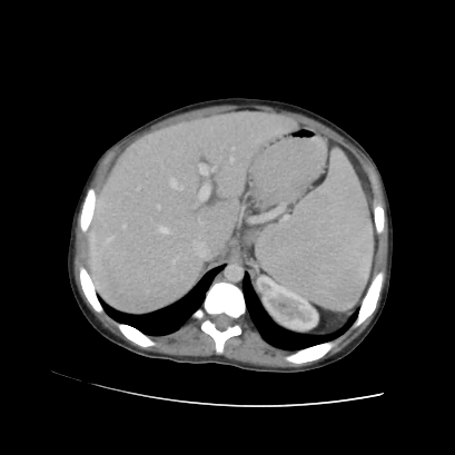 Acute calculous cholecystitis in patient with osteopetrosis (Radiopaedia 77871-90159 Axial C+ portal venous phase 25).jpg