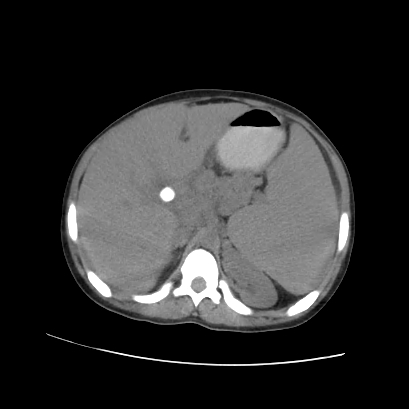 File:Acute calculous cholecystitis in patient with osteopetrosis (Radiopaedia 77871-90159 Axial non-contrast 29).jpg