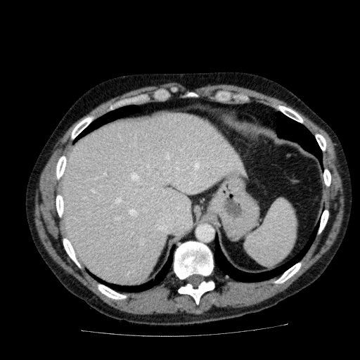 Acute cholecystitis and incidental left sided IVC (Radiopaedia 49352-54459 Axial C+ portal venous phase 35).jpg