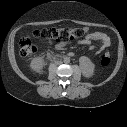 Acute cholecystitis and ureteric colic (Radiopaedia 42330-45444 Axial prone 53).jpg