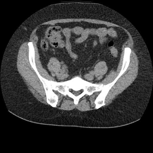 File:Acute cholecystitis and ureteric colic (Radiopaedia 42330-45444 Axial prone 78).jpg
