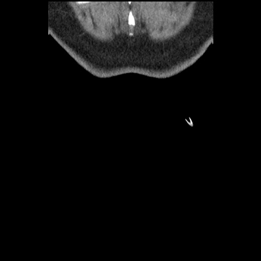 Acute cholecystitis and ureteric colic (Radiopaedia 42330-45444 Coronal prone 104).jpg