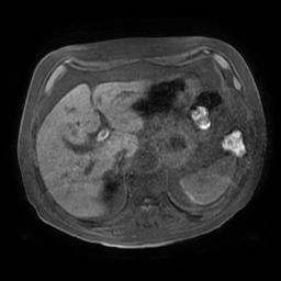 Acute cholecystitis complicated by pylephlebitis (Radiopaedia 65782-74915 Axial T1 fat sat 35).jpg