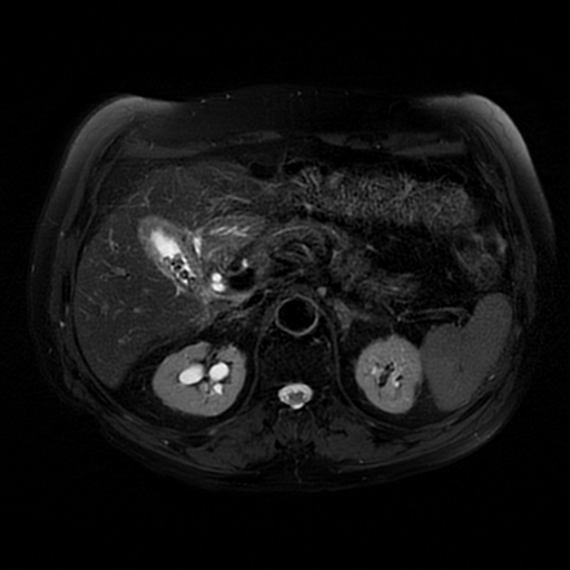 File:Acute cholecystitis complicated by pylephlebitis (Radiopaedia 65782-74915 Axial T2 fat sat 22).jpg
