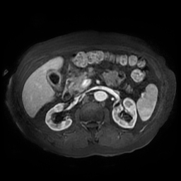 Acute cholecystitis complicated by pylephlebitis (Radiopaedia 65782-74915 Axial arterioportal phase T1 C+ fat sat 72).jpg