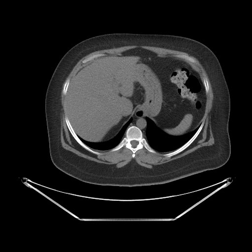 File:Acute cholecystitis with tensile fundus sign (Radiopaedia 71394-81723 Axial non-contrast 4).jpg