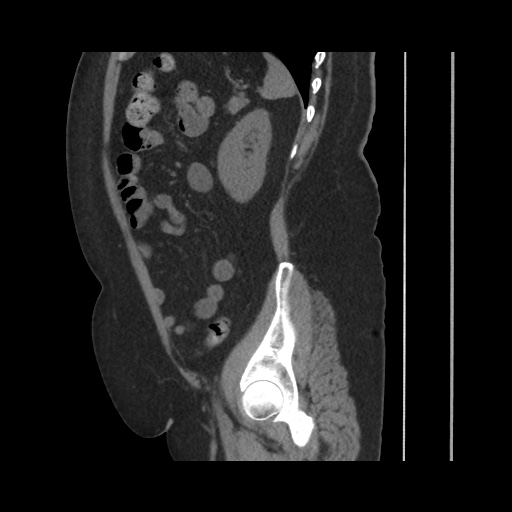 File:Acute cholecystitis with tensile fundus sign (Radiopaedia 71394-81723 Sagittal non-contrast 121).jpg