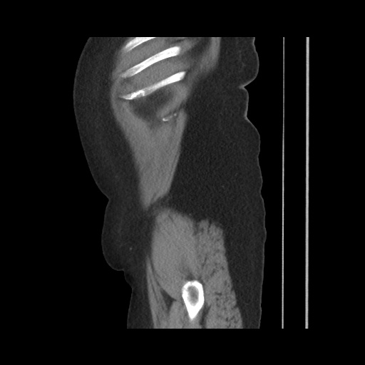 Acute cholecystitis with tensile fundus sign (Radiopaedia 71394-81723 Sagittal non-contrast 35).jpg