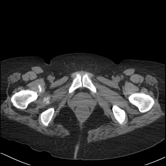 Acute colonic hemorrhage in ulcerative colitis (Radiopaedia 77415-89538 Axial non-contrast 140).jpg