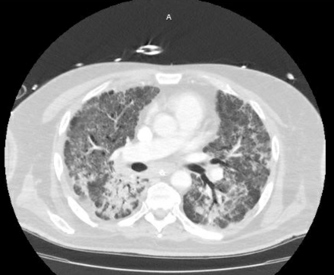File:Acute cor pulmonale (ultrasound) (Radiopaedia 83508-98818 Axial lung window 44).jpg