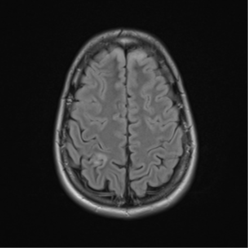 File:Acute disseminated encephalomyelitis (ADEM) (Radiopaedia 65319-74349 Axial FLAIR 25).png