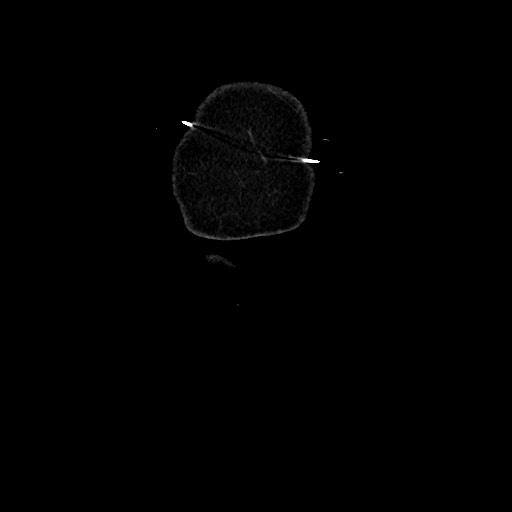 Acute diverticulitis - transverse colon (Radiopaedia 87063-103327 Coronal C+ portal venous phase 10).jpg