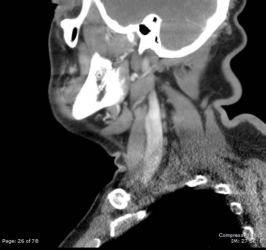 Acute epiglottitis (Radiopaedia 54375-60590 Sagittal C+ arterial phase 26).jpg