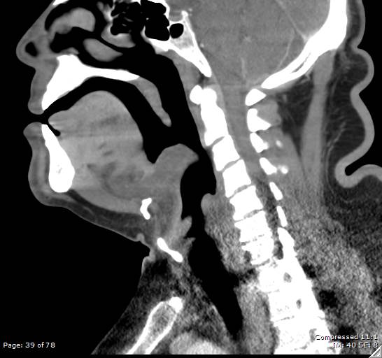 Acute epiglottitis (Radiopaedia 54375-60590 Sagittal C+ arterial phase 39).jpg