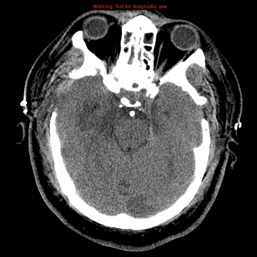 Acute hemorrhagic leukoencephalitis (Radiopaedia 14076-43697 Axial non-contrast 16).jpg
