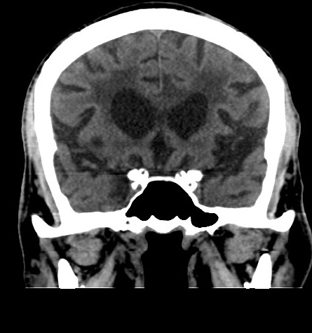 Acute left anterior cerebral artery territory infarction (Radiopaedia 51785-57578 Coronal non-contrast 23).jpg