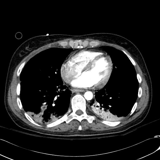 File:Acute myocardial infarction in CT (Radiopaedia 39947-42415 Axial C+ arterial phase 92).jpg