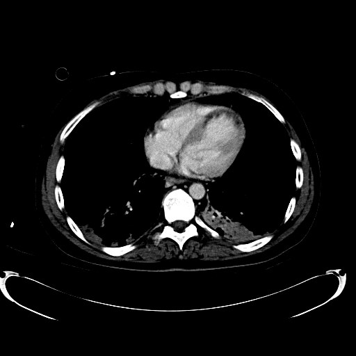 File:Acute myocardial infarction in CT (Radiopaedia 39947-42457 Axial C+ portal venous phase 4).jpg