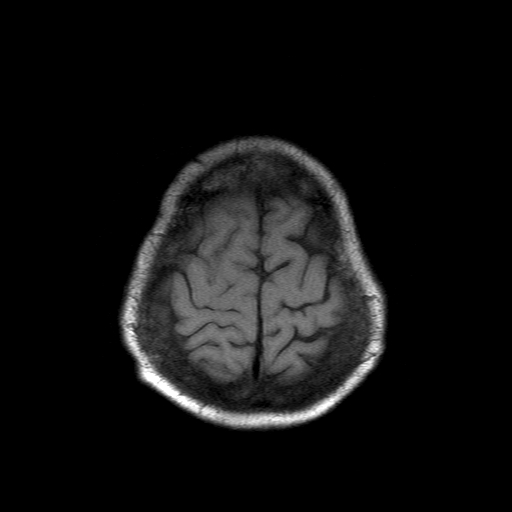File:Acute necrotizing toxoplasma encephalitis (Radiopaedia 10683-11149 Axial T1 2).jpg