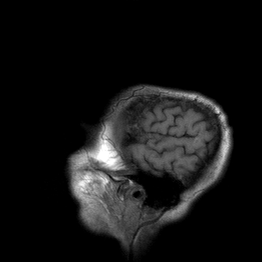 File:Acute necrotizing toxoplasma encephalitis (Radiopaedia 10683-11149 Sagittal T1 fat sat 18).jpg
