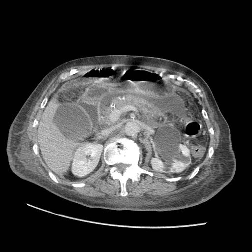 Acute on chronic pancreatitis (Radiopaedia 13233-13244 Axial C+ portal venous phase 37).jpg