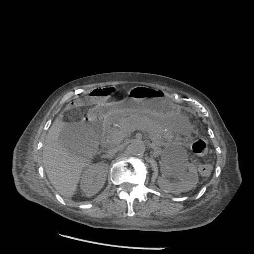 Acute on chronic pancreatitis (Radiopaedia 13233-13244 Axial non-contrast 33).jpg