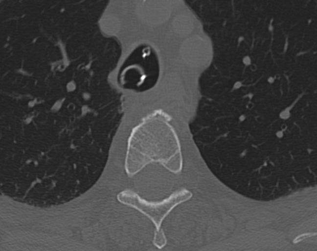 Acute on chronic subdural hematoma and thoracic vertebral injury in a multitrauma patient (Radiopaedia 31698-32619 Axial bone window 75).jpg