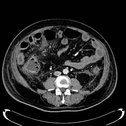 Acute pancreatic necrosis (Radiopaedia 13560-18500 Axial C+ portal venous phase 93).jpg