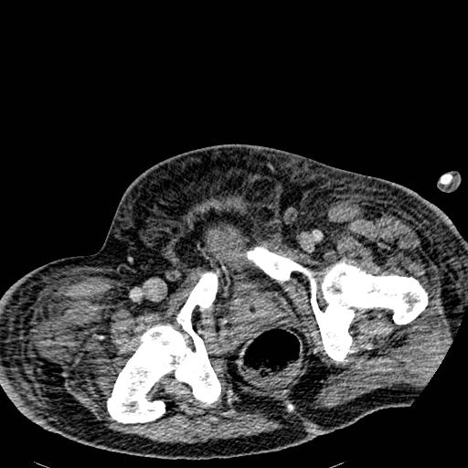 Acute pancreatic necrosis (Radiopaedia 13560-18501 Axial C+ portal venous phase 146).jpg