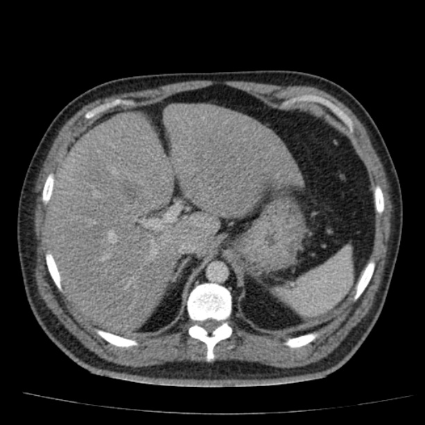 Acute pancreatitis (Radiopaedia 26663-26813 Axial C+ portal venous phase 19).jpg