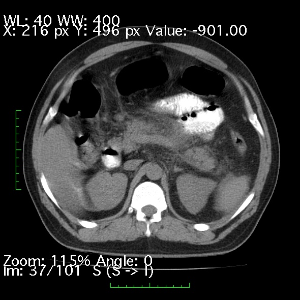 Acute pancreatitis (Radiopaedia 34043-35276 Axial non-contrast 37).jpg