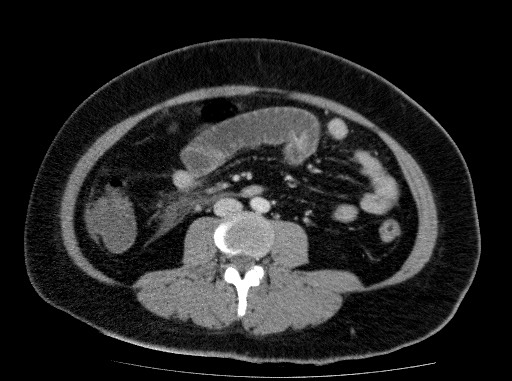 Acute pancreatitis (Radiopaedia 69236-79012 Axial C+ portal venous phase 53).jpg