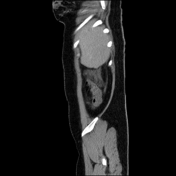 Acute pancreatitis (Radiopaedia 69236-79012 Sagittal C+ portal venous phase 84).jpg