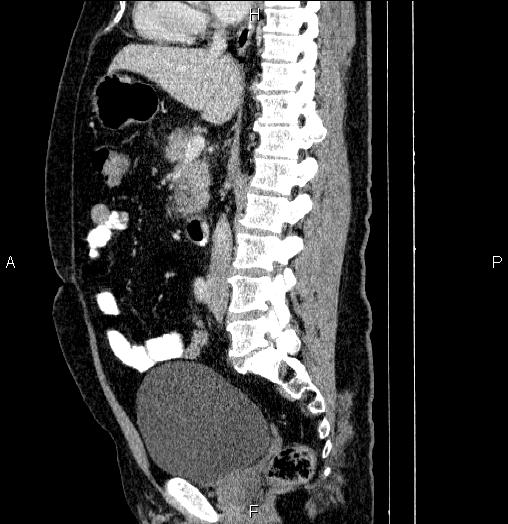 Acute pancreatitis (Radiopaedia 85390-101010 Sagittal C+ portal venous phase 48).jpg