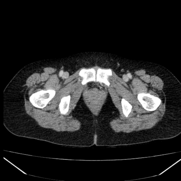 Acute pancreatitis - Balthazar C (Radiopaedia 26569-26714 Axial C+ portal venous phase 96).jpg