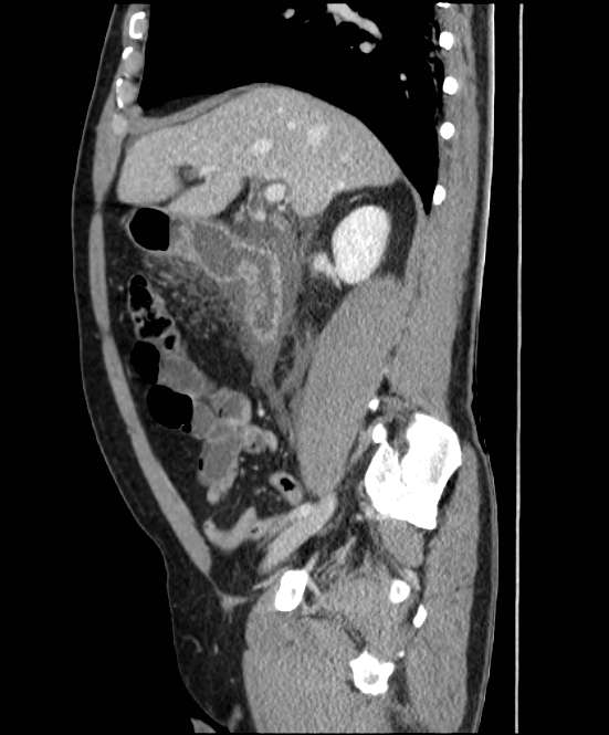 Acute pancreatitis - Balthazar E (Radiopaedia 23080-23110 Sagittal C+ portal venous phase 33).jpg