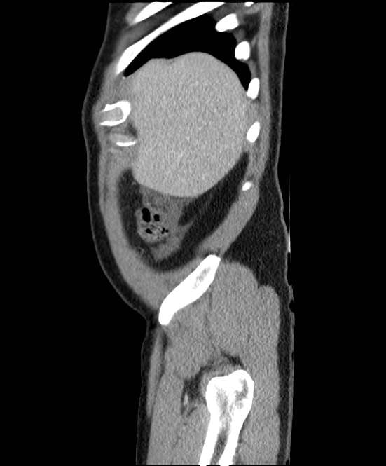 Acute pancreatitis - Balthazar E (Radiopaedia 23080-23110 Sagittal C+ portal venous phase 8).jpg
