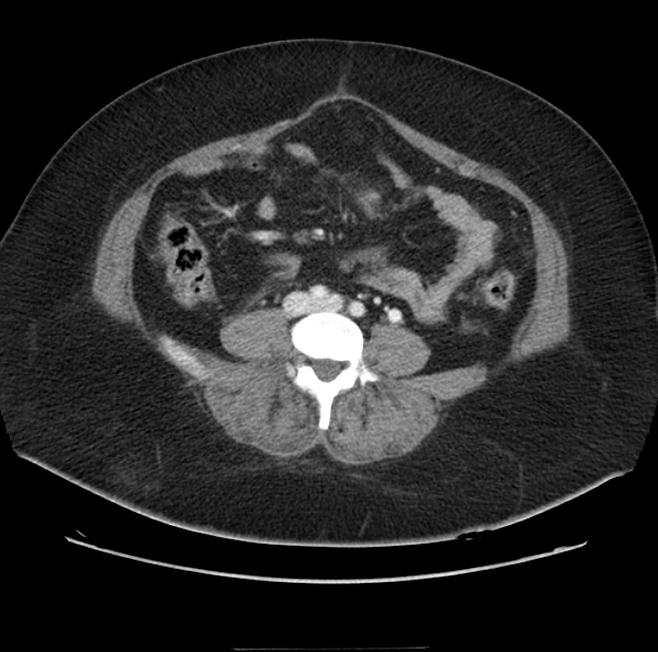 File:Acute pancreatitis - Balthazar E (Radiopaedia 29016-29377 Axial C+ portal venous phase 45).png